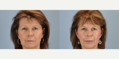 54 year old woman treated with Lip Augmentation - This 54 year old woman underwent Lip Augmentation by method of Autologous Fat Transfer.
