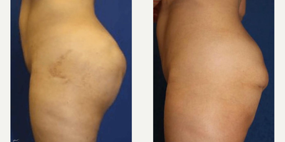 25-34 year old woman treated with Butt Implants - This 32-year-old female patient had silicone injected into their buttocks by another doctor and experienced multiple painful complications. So, Dr. Katzen had the dangerous silicone removed using ultrasound guided VASER assisted silicone and scar suction. The patient also had buttock implants inserted by Dr. Katzen.