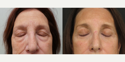 55-64 year old woman treated with Eyelid Surgery, Brow Lift - This patient underwent a Facelift, Endoscopic browlift, Upper/Lower Lid Blepharoplasty, Fat Transfer to glabella, forehead, lateral brow, n/l folds, oral commissures, cheeks, fine lines around the lips, lips and chin