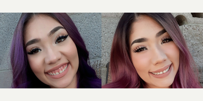 18-24 year old woman treated with Botox for Gummy Smile - This patient was concerned about her 'gummy smile'. The doctoradministered botox and filler to the upper lip to correct it.