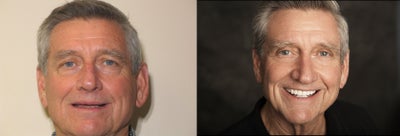 Upper and Lower Veneers -
Patient unhappy with worn down, chipped, discolored teeth resulting in less than satisfactory smile. Smile restored with upper and lower porcelain veneers.