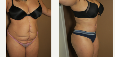 35-44 year old woman treated with Liposuction - Pro bono tummy tuck and liposuction - reconstruction after car accident