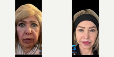 55-64 year old woman treated with Facelift, Facial Fat Transfer, Eyelid Surgery, Canthoplasty, Lip Lift, Neck Lift, Brow Lift - Pleasant results after full facelift.