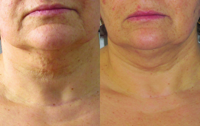 Venus Legacy - Before and After 10 Treatments.  Photos provided courtesy of Venus Concept.