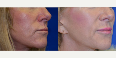 45-54 year old woman treated with Lip Augmentation - Age: 50 - 59. This patient came in wanting a more permanent solution for volume to the lips. After being evaluated by Dr. Ho and reviewing her options for treatment, the patient elected to have the lip implant procedure performed.