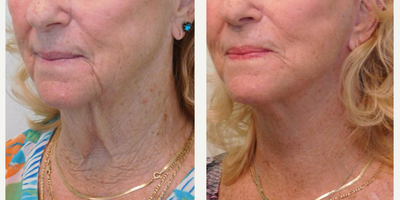 55-64 year old female treated with Lower Face Lift and Neck Lift - This active middle-aged woman noticed her early signs of neck aging in her 40's. She stated that both of her parents had turkey necks at an early age (by age 50) as well. She stated that she tried a few non-procedure treatments (ie creams/peels/lasers etc.) with little improvement in her areas of concern (neck and jowls). After thorough consultation together we decided to perform a lower facelift and necklift. We performed the procedure safely and comfortably in our Center under local anesthesia and mild oral sedation (with Valium). Her after photo demonstrates significant improvement in her neck and jawline contour, folds, and wrinkles, while still maintaining a natural and healthy appearance.