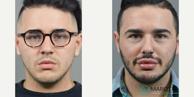 Lip Fillers - Man treated with Lip Lift