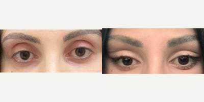 35-44 year old woman treated with Canthoplasty - 35-44 year old woman treated with Canthoplasty