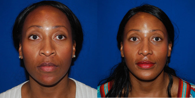 Chin Augmentation - Chin Augmentation