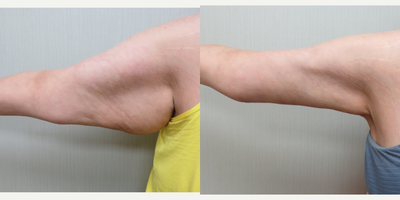 35-44 year old woman treated with Arm Lift - This patient underwent Liposuction to her anterior/ lateral arms along with skin removal/ Brachioplasty