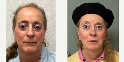 65-74 year old woman treated with Adam's Apple Reduction, Brow Bone Reduction, Brow Lift, Septoplasty, Rhinoplasty, Lip Lift, Ch - This lady underwent facial feminization surgery including forehead feminization, nasal feminization, cheek augmentation, chin feminization and adams apple reduction.