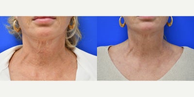 55-64 year old woman treated with Ellacor - This patient had only 1 Ellacor treatment to her neck 10 weeks ago. Huge improvement!