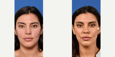 Woman treated with Dermal Fillers, Cheek Fillers - With subtle actors-dose Botox to help raise the tail of the brows, and gentle filler to the lips, cheeks, and jaw, we were able to create a natural, yet refined look.
