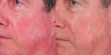 Rosacea Treatment