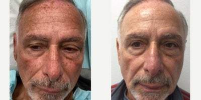 65-74 year old man treated with Fraxel Laser, Laser Peel, Skin Lightening - 71 year old treated with fraxel & ruby laser for sun damage brown spots