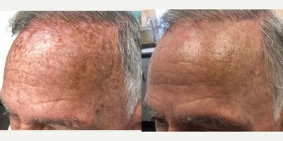 65-74 year old man treated with Fraxel Laser, Laser Peel, Skin Lightening - 71 year old treated with fraxel & ruby laser for sun damage brown spots