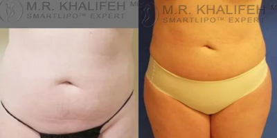 Woman treated with Liposuction - Woman treated with Liposuction