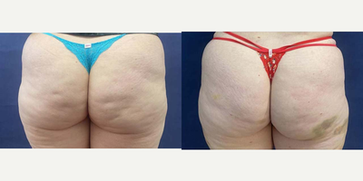 25-34 year old woman treated with Aveli - 1-week Post-op: Patient is still bruised