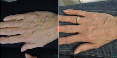 Woman treated with Skin Rejuvenation - Woman treated with Skin Rejuvenation