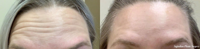 25-34 year old woman treated with Botox - Before (top) & After (bottom) Botox