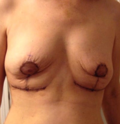 Breast Implant Doctors In Ga 24