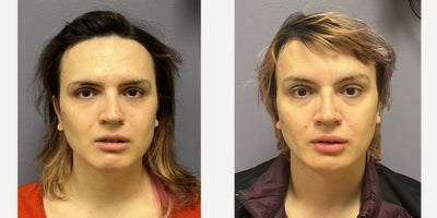 25-34 year old woman treated with Forehead Reduction, Brow Lift, Brow Bone Reduction, Rhinoplasty, Lip Surgery, Genioplasty, Fac - This lady underwent forehead feminization, feminizing rhinoplasty, chin feminization and lip augmentation.