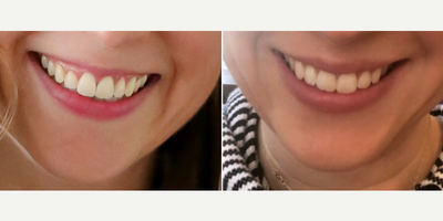 35-44 year old woman treated with Botox for Gummy Smile - Botox for lip flip and gummy smile