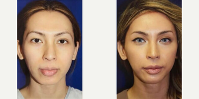Woman treated with Forehead Reduction - Woman treated with Forehead Reduction (Hairline Advancement)