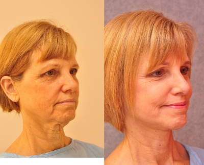 55 y.o. woman who want to look how she feels - This woman came in stating she wanted to look younger. She was especially concerned with her neck, the areas around her mouth, and her cheeks. She had her procedure in our office OR with oral sedation and local infiltration.