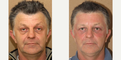 Man treated with Laser Resurfacing - Man treated with Laser Resurfacing