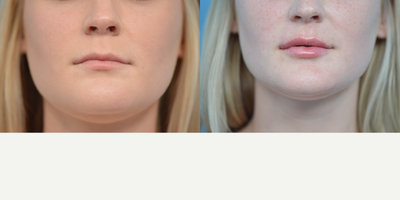 18-24 year old woman treated with Volbella - 24 year old concerned with lack of volume in her lips. Volbella was injected to giver lips a fuller, natural appearance