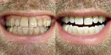 zoom teeth whitening groupon