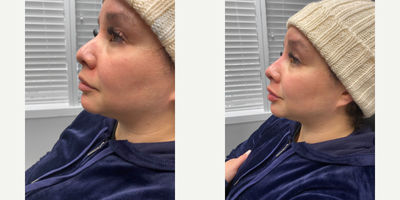 35-44 year old woman treated with Nonsurgical Nose Job - This 41-year-old patient was looking for minimal, non-invasive improvements. The doctor performed a non-surgical rhinoplasty to better define the tip of her nose. After photos were taken immediately following the injections, the patient was absolutely in awe with her new, more balanced features.