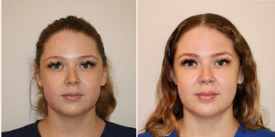 25-34 year old woman treated with Buccal Fat Removal - This is a 25 year old female shown before and at six weeks postoperative buccal fat removal.