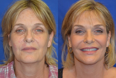 50-59 year old woman treated with CO2 Laser - 50-59 year old woman treated with CO2 Laser