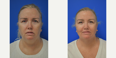 55-64 year old woman treated with Facelift, Chin Liposuction - She had no wrinkles but her full neck made her look a lot older than her 55 years! Dr Pautler did a lower face and neck lift on her and now she has a youthful jawline and younger appearance.