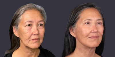 55-64 year old woman treated with Chemical Peel, Eyelid Surgery, Facelift, Lower Facelift, Neck Lift, TCA Peel, Velashape - 63 year old woman who is 5'3 tall and weighs 153 pounds. She had an upper eyelid lift, TCA chemical peel around the eyes, and a lower face and neck lift. Her after photos are at 6 months.