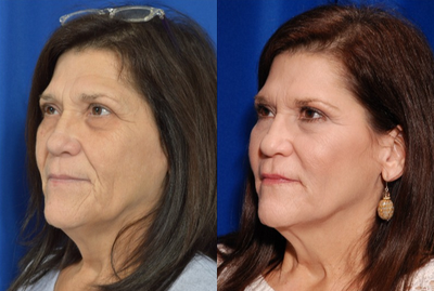 55-64 year old woman treated with Non Surgical Face Lift - Non Surgical Face Lift performed by Facial Plastic Surgeon, Sean R. Weiss, MD