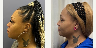 35-44 year old woman treated with Forehead Reduction, Brow Bone Reduction, Brow Lift, Facial Feminization Surgery - This young lady underwent forehead feminization, and chin feminization.