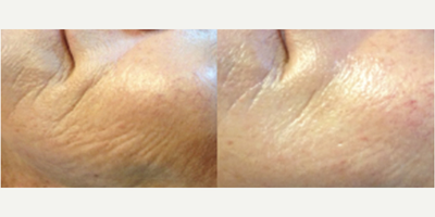 25-34 year old woman treated with Microneedling - Microneedling is one of the newest and most effective manners to improve the lines of the face with Zero downtime and Amazing results.