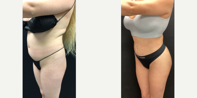 35-44 year old woman treated with Smart Lipo - Patient presented for liposuction to upper back, abdomen and flanks with a fat transfer to the buttocks.