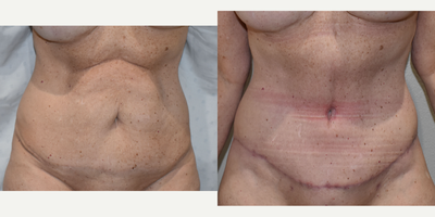 45-54 year old woman treated with Tummy Tuck Revision - The patient had a mini-abdominoplasty by another surgeon and was revised to full abdominoplasty in Southlake.