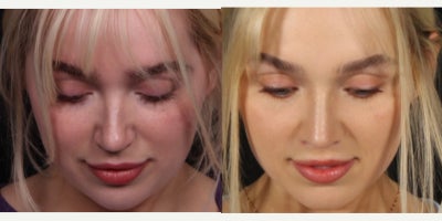 25-34 year old woman treated with Rhinoplasty, Lip Lift - Combing lip lift with rhinoplasty for this beautiful patient! She looks great before and great after, but we are loving the subtle early change to her upper lip 2 months post op. And the nose looks great too - feminine and natural. She is always positive and kind to our team. We really appreciate her and other patients like her.