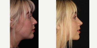 25-34 year old woman treated with Rhinoplasty, Lip Lift - Combing lip lift with rhinoplasty for this beautiful patient! She looks great before and great after, but we are loving the subtle early change to her upper lip 2 months post op. And the nose looks great too - feminine and natural. She is always positive and kind to our team. We really appreciate her and other patients like her.