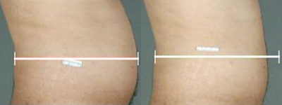 Liposonix - 
	This patient underwent treatment with Liposonix, a non invasive method of shrinking subcutaneous fat using high frequency focused ultrasound. After a single treatment, lasting about an hour, the patient gradually lost fat over the abdominal area over a period of 12 weeks after treatment with Liposonix. Toronto patients enrolled in a recent study of Liposonix had a satisfaction rate of 90% with the treatment. Treatment with Liposonix involves no incision of any kind, and no significant downtime. The front and lateral views of this patient demonstrate a typical degree of fat loss, the average being 2.8cm reduction in waste measurement which translates into one pant or skirt size. Liposonix is not for overweight individuals but can be considered in patients like this one, who are close to their ideal body weight and have good skin tone.