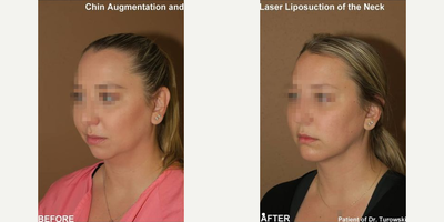 Woman treated with Chin Liposuction - Woman treated with Chin Liposuction