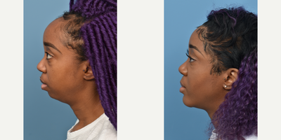 25-34 year old woman treated with Chin Implant - This patient underwent a chin implant procedure to augment her chin.