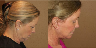 Woman treated with Facelift - Woman treated with Facelift