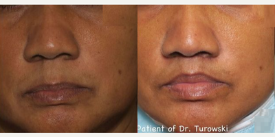 Woman treated with Lip Lift - Woman treated with Lip Lift