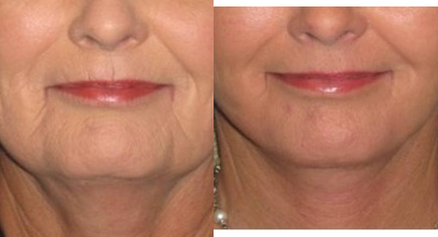 45-54 year old woman treated with Fractional Laser of Mouth - In addition to a lower facelift/necklift, this woman requested rejuvenation of her perioral (mouth) area. We performed one treatment of a fractional CO2 laser simultaneously on the day of her facelift. As her post-procedure picture demonstrates, the texture of skin around her mouth, along with the vertical wrinkles, are significantly improved. Fractional CO2 laser treatment is often combined with a facelift to yield these results. Her procedures were performed in our office under local anesthesia and sedation.